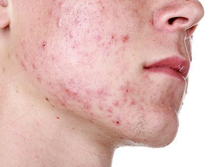 A Closer Look at Some of the Different Types of Acne