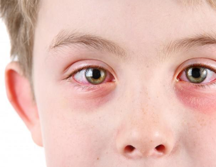 Helping Your Child Recover From Pink Eye